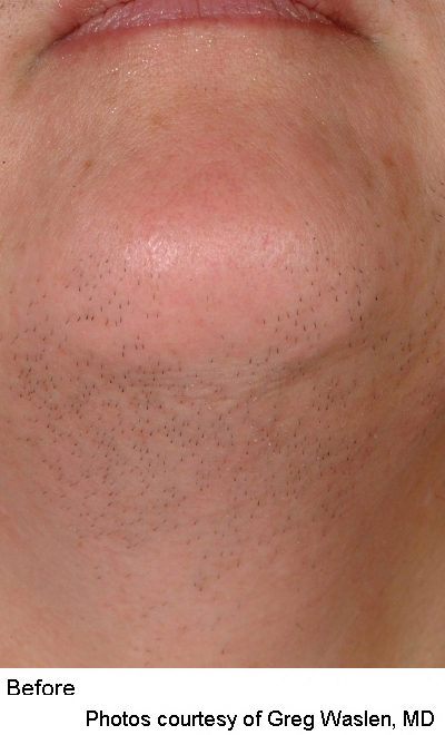 Before and after photo 2